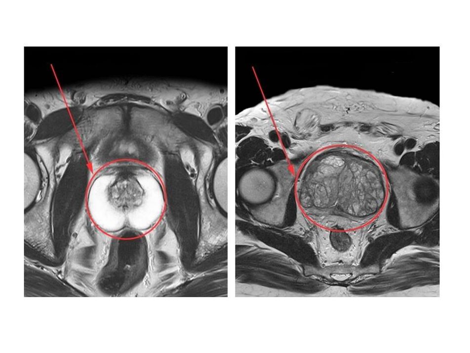 Comparison of a healthy (left) and inflamed (right) prostate on MRI images